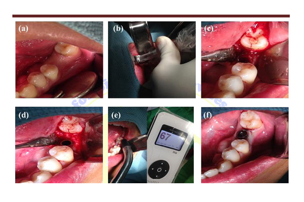 Integration of development on  Biomate Dental Implant System