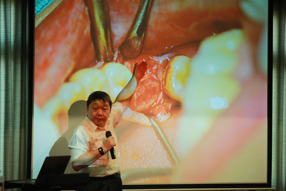 Biomate IAI -Sinus Lift-Crestal / Approach Tranning Course by Prof.Tao Chiang