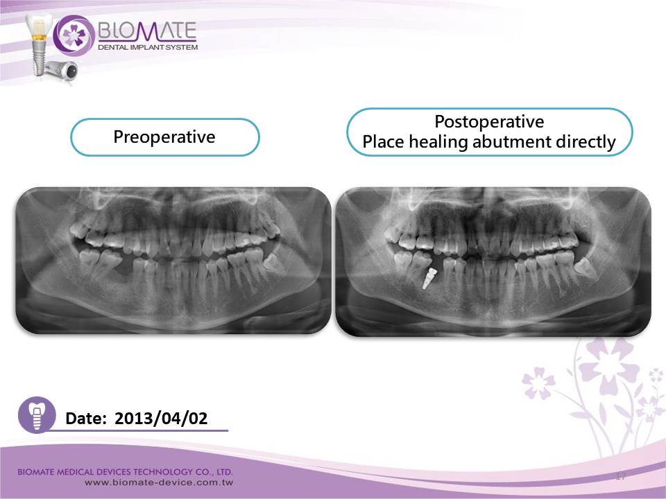 Biomate Implant Academy Institute-Clinical Case Report