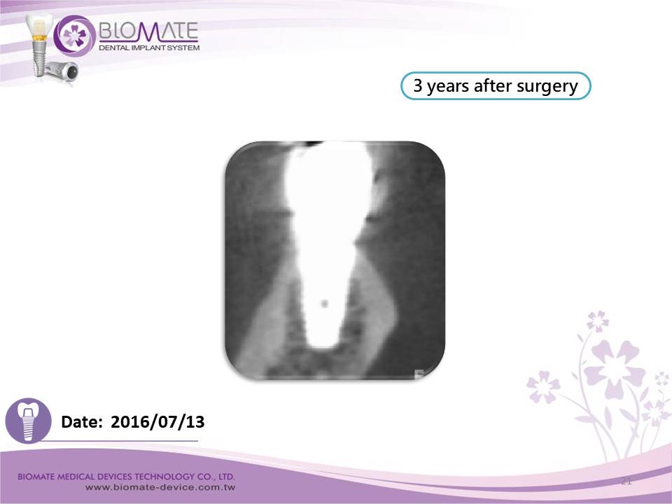 Biomate Implant Academy Institute-Clinical Case Report
