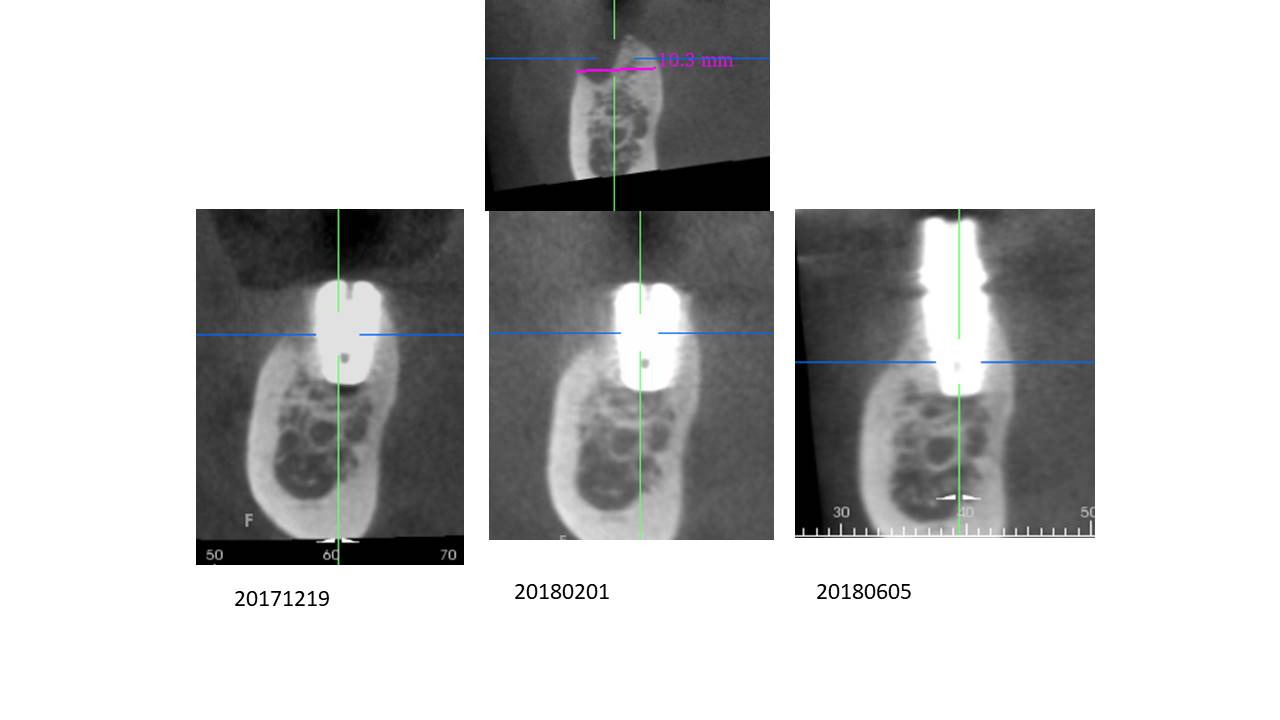 Biomate Implant Academy Institute-Clinical Case Report